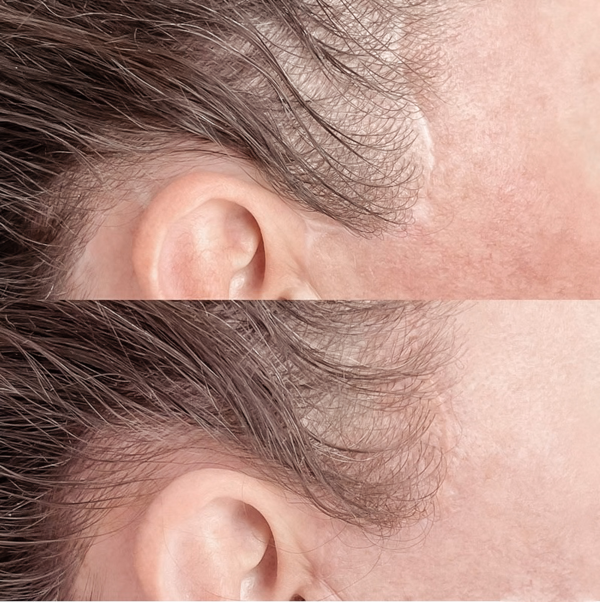 facelift scar around the hairline - Rancho Mirage, CA