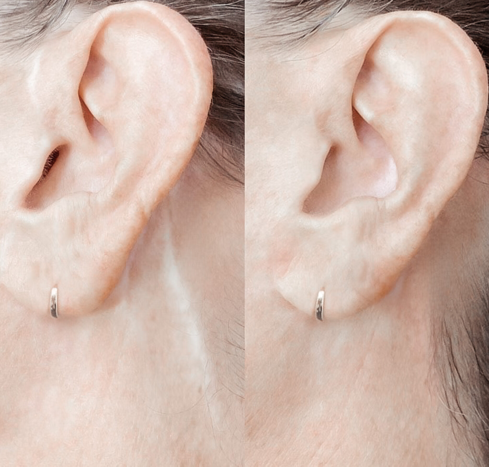 facelift scar behind the ears, DermaLUX, CA