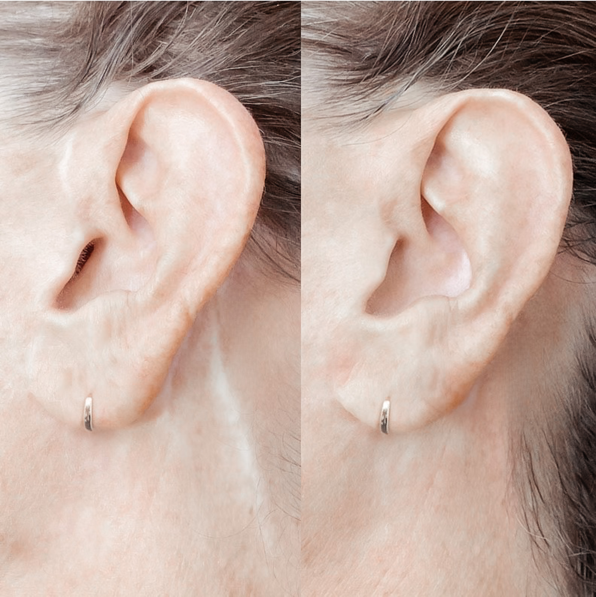 facelift scar behind the ears, Palm Desert, CA