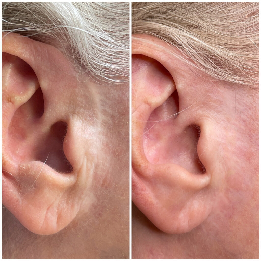 Facelift scar around ear