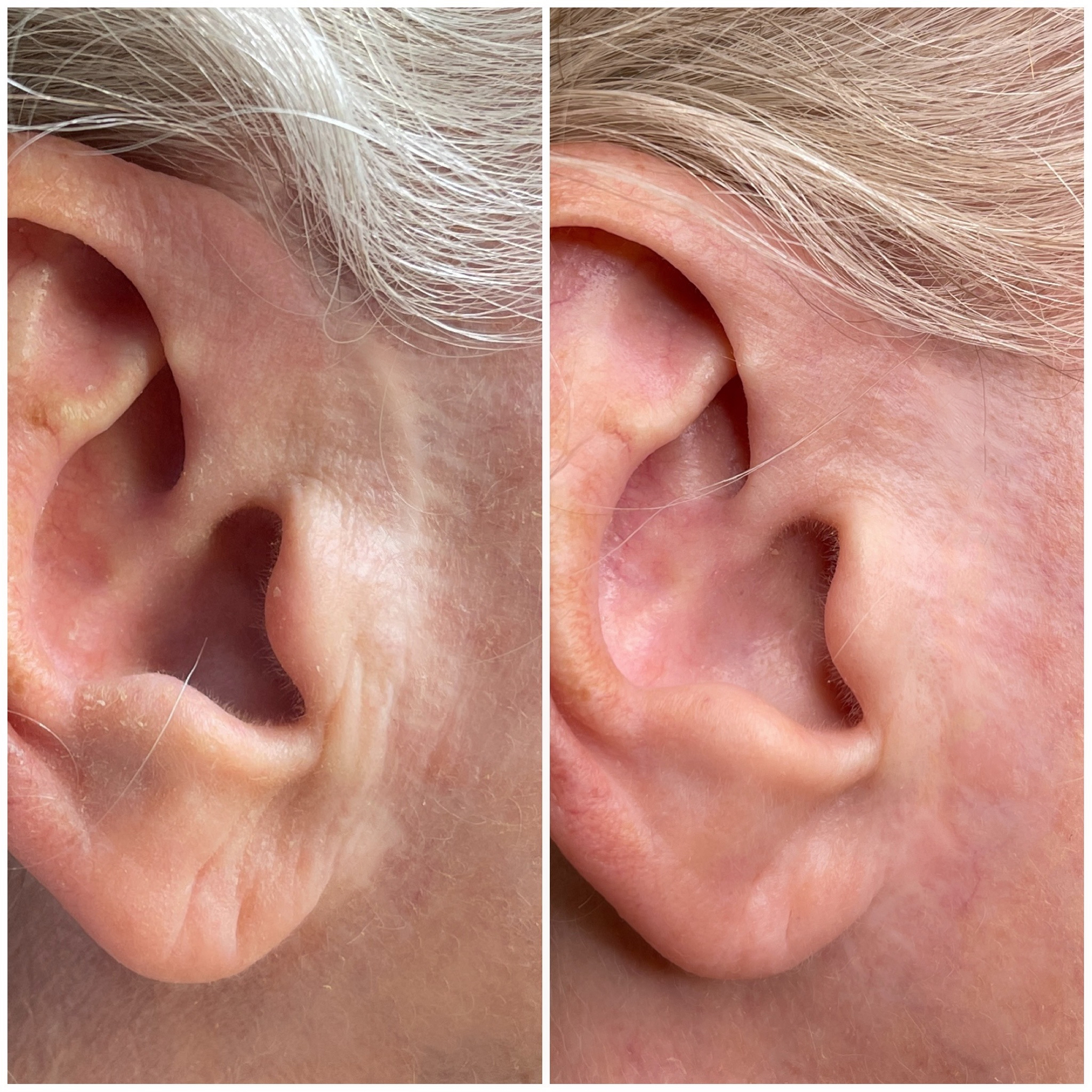 Facelift scar around ear